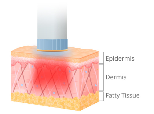 Вакуумно-роликовый аппарат с RF-терапией и инфракрасным излучением Omnislim фото 7