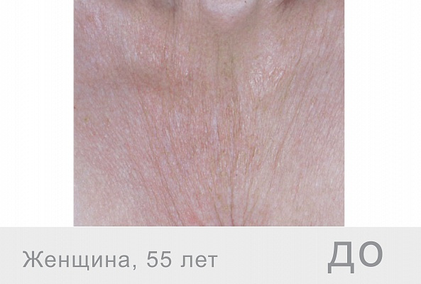 F-XFC FACE Гиалуроновая кислота+ДМАЕ+органический кремний, 10мл фото 3