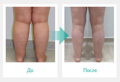 Аппарат прессотерапии Doctor life Mark 400 (Южная Корея) фото 3