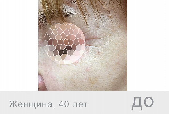 BEAUTELLE 40+ (шприц 2мл) фото 3