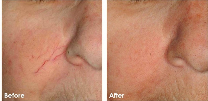  Лазерная платформа DIO LIGHT (diode + ipl) фото 7