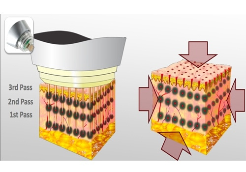 Аппарат микроигольчатого RF лифтинга Dermatrix DUO (GSD) фото 7