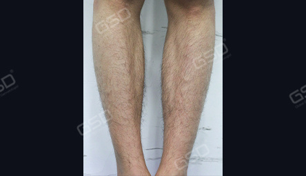 Диодный лазер COOLITE BOLT 1800W фото 8